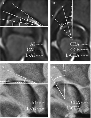 Cartilaginous predictors of residual acetabular dysplasia (RAD) in developmental dysplasia of the hip following closed or open reduction: A systematic review and meta-analysis